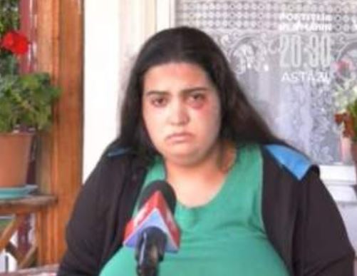 Tânără desfigurată de iubit