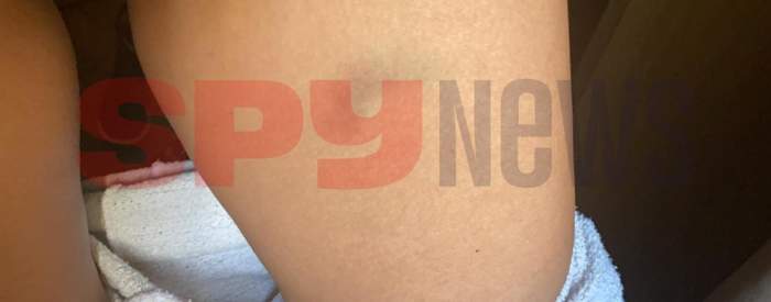 Bianca Pop vânătaie/ sursă foto spynews Bianca Pop batuta