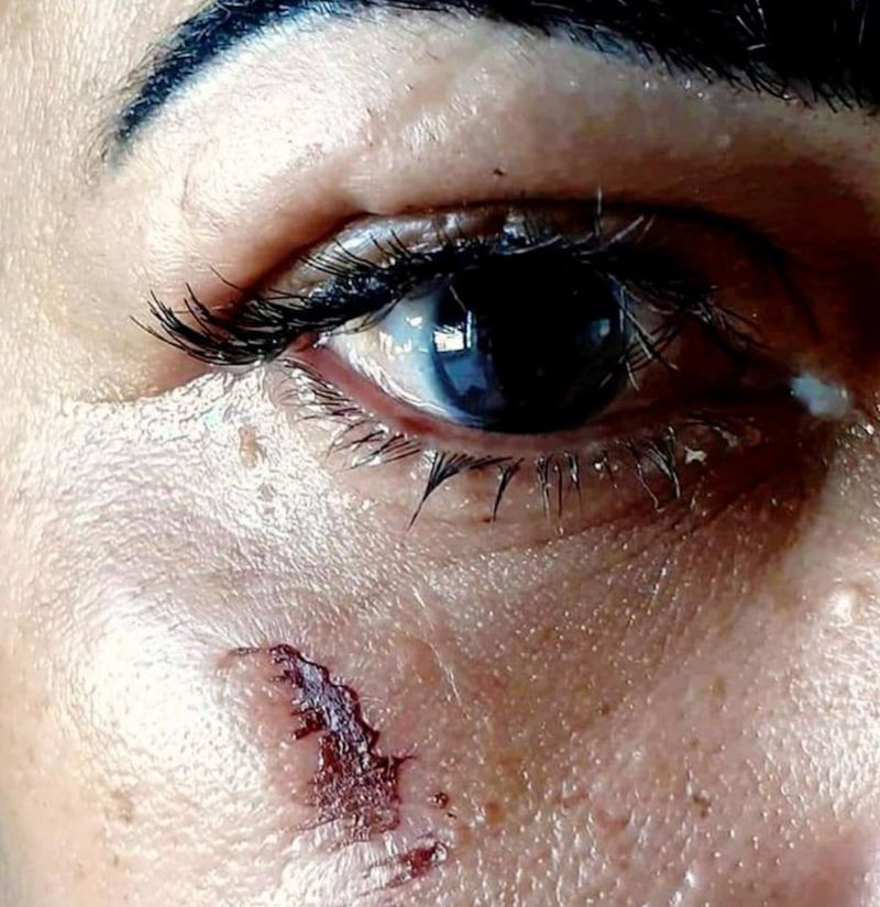 Femeia care a suferit un accident &icirc;n timp ce &icirc;și punea gene false