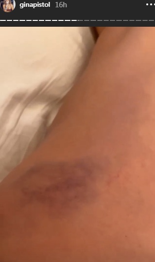 Gina Pistol s-a rănit grav, în urma unei căzături