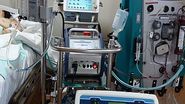 ECMO
