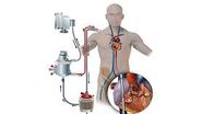 ecmo