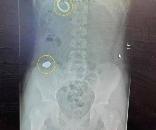 Este incredibil ce au găsit medicii în stomacul unui copil! Este incredibil ce au găsit medicii în stomacul unui copil!
