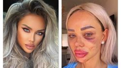 Imagini înfiorătoare cu Bianca Drăgușanu snopită în bătaie! A făcut totul public: „Să vedeți prin ce am trecut! Am fost proasta că am tăcut” FOTO