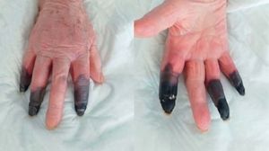 Caz șocant! O femeie din Italia, infectată cu SARS-CoV-2, a rămas fără trei degete