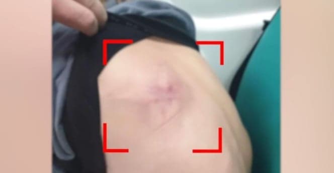 Loviturile cozii de mătură i-au rămas imprimate fetei pe spate