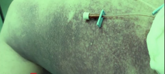 coronavirus