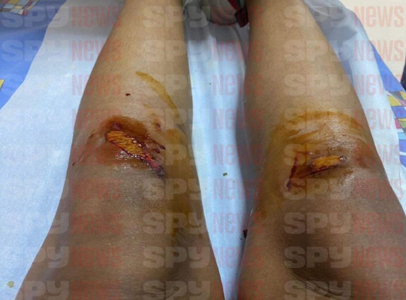 Imagine șoc cu rănile lui Laurette!