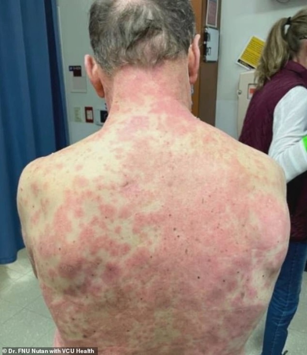 Vaccinul Johnson&amp;Johnson a provocat o reacție adversă severă unui bărbat