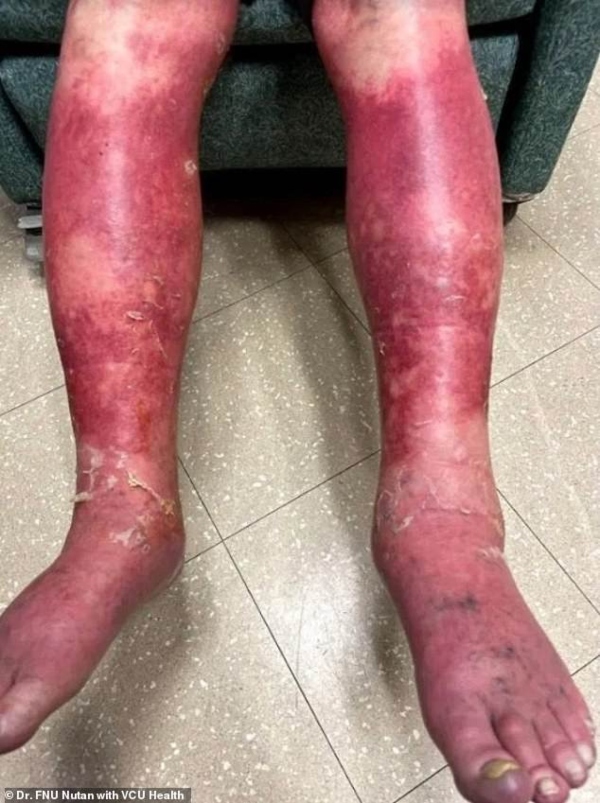 Vaccinul Johnson&amp;Johnson a provocat o reacție adversă severă unui bărbat