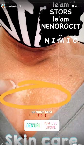 Dorian Popa a avut două chisturi pe piept