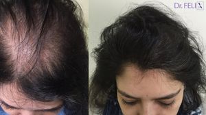 Implant de păr femei