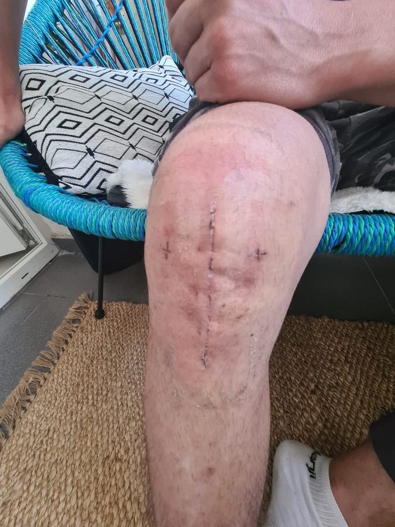 Genunchiul proaspăt operat al lui Lucian Barbu