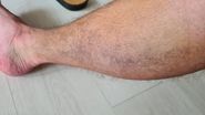 Vânătile de pe picioarele fostului Războinic