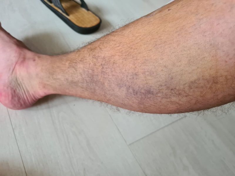Vânătile de pe picioarele fostului Războinic