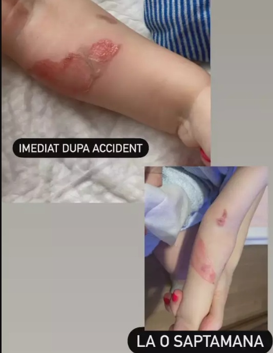 Tily Niculae a trecut prin momente cumplite. Fiul actriței a suferit o arsură de gradul 2: &quot;Simțeam cum îmi vine să urlu&quot;