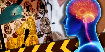 O nouă boală misterioasă a creierului a fost descoperită de cercetători