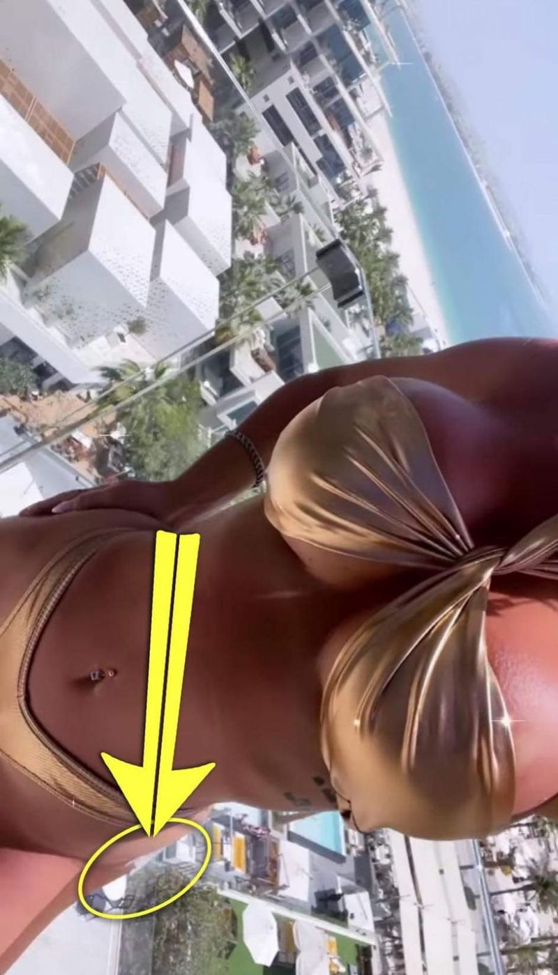 Loredana Chivu, cu bandajele pe posterior 