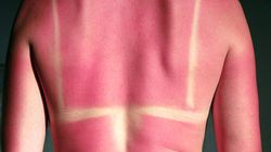 Ce să faci dacă te-ai ars la soare. Remedii rapide pentru arsurile solare