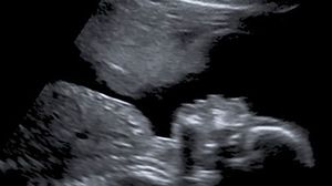 Stacey crede că în ecografia bebelușului se vede un înger