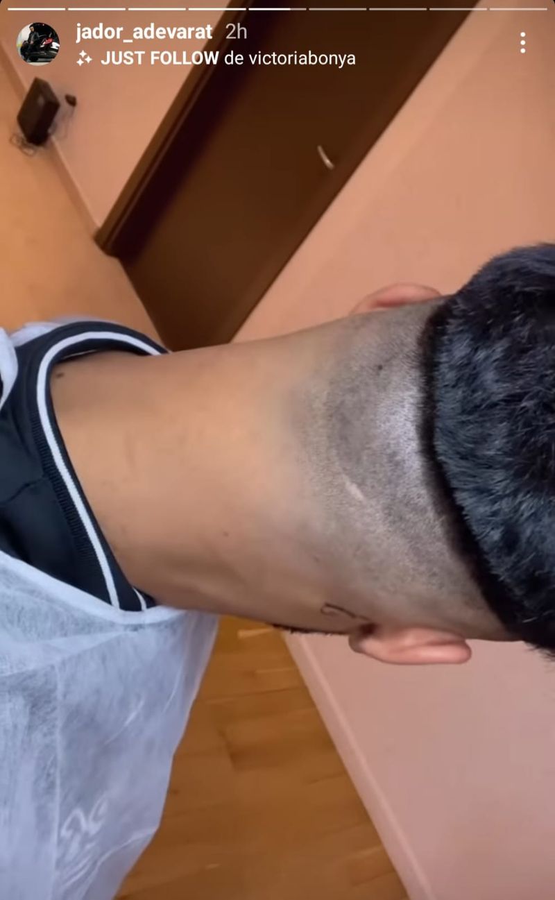 Jador își face implant de păr