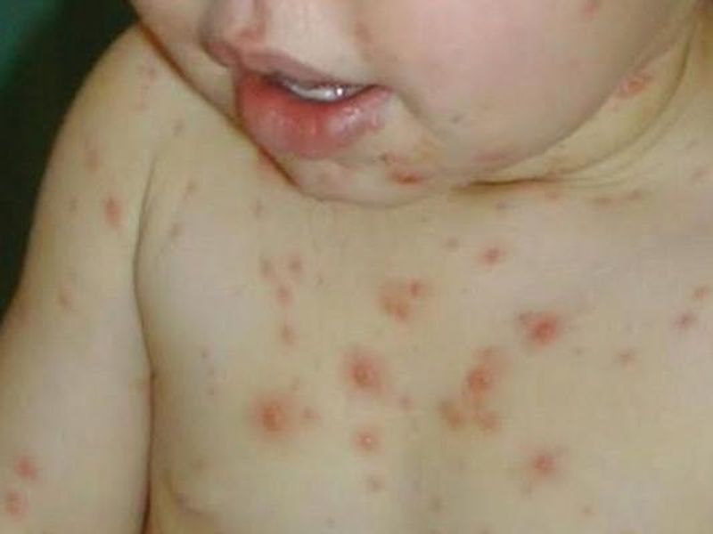 Ce virus a reapărut în România, după ani de la ultima infectare! Cazurile au explodat în acest județ