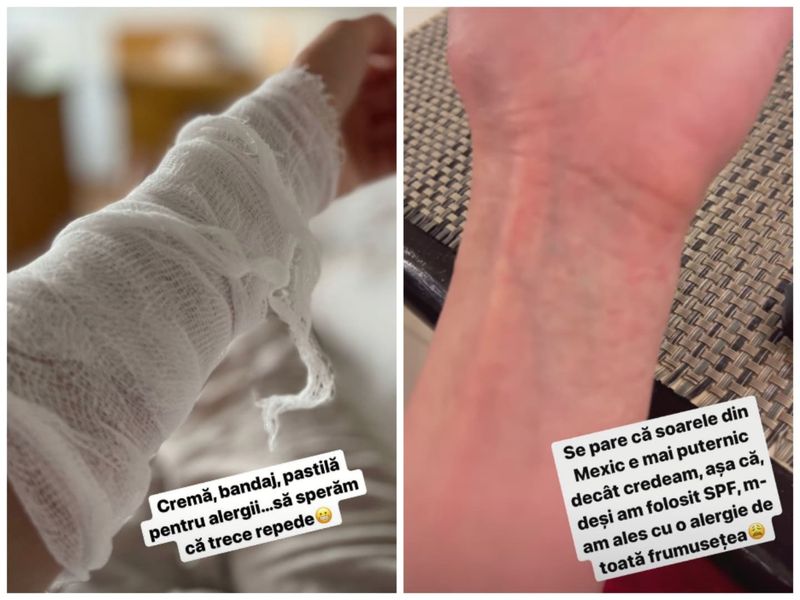 Irina Fodor a apărut cu mâna plină de bandaje