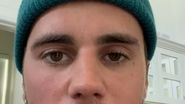 Justin Bieber suferă de sindromul Ramsay Hunt