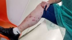 A mers în vacanță să se relaxeze, dar a ajuns de la hotel la spital! Ce s-a întâmplat cu turista la Băile Felix