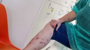 ploșnite, turistă, hotel, vacanță de coșmar, băile felix