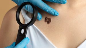 cum protejam alunitele