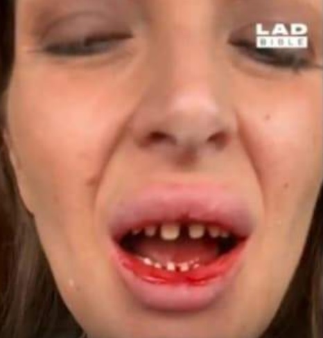 fatete dentare, turcia, stomatologie