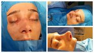 Amarah operație de rinoplastie