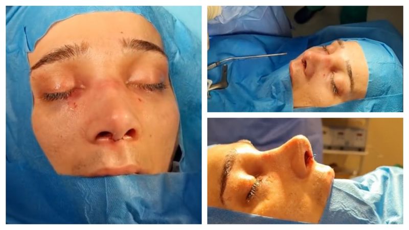 Amarah operație de rinoplastie