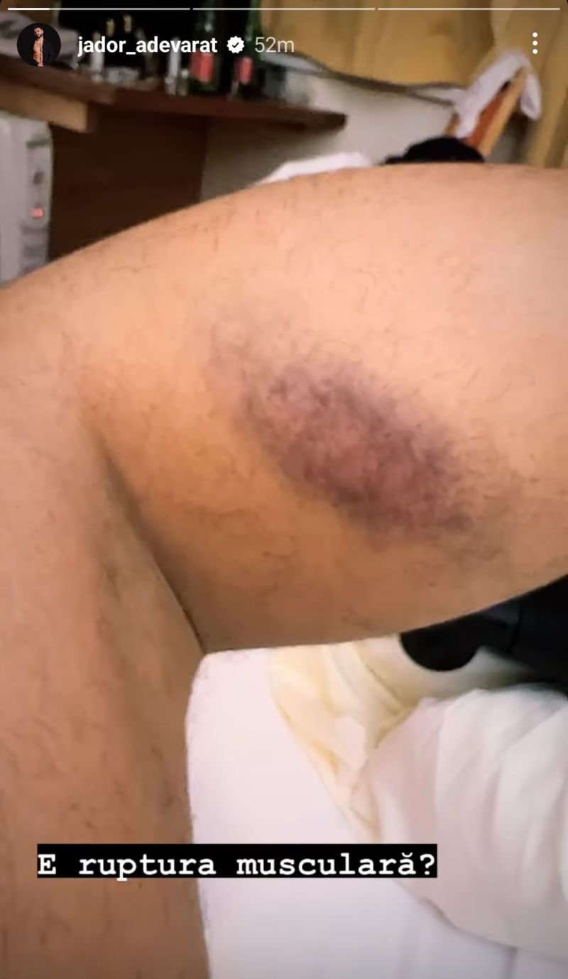 Jador ruptură musculară