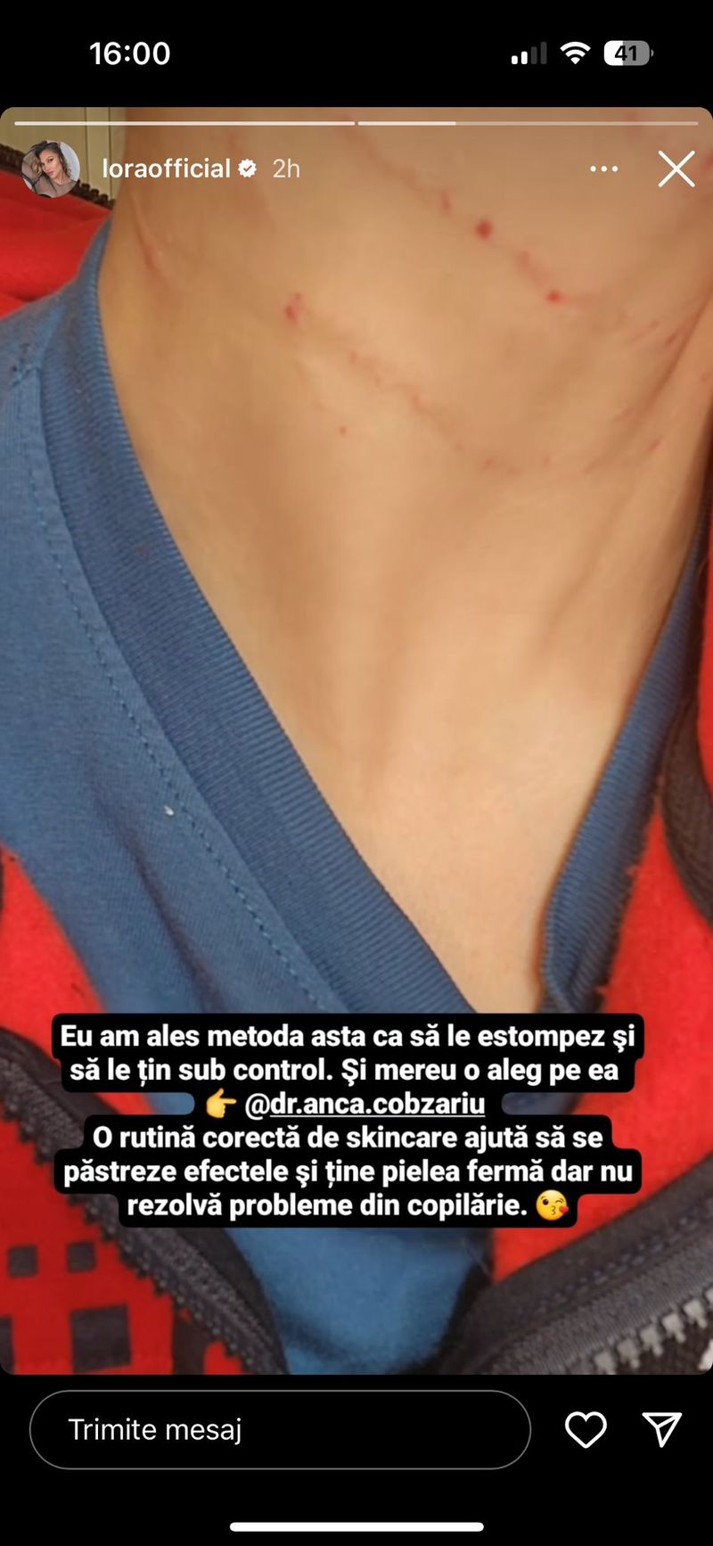 lora, procedura estetica, interventie, riduri, tinerete, frumusete