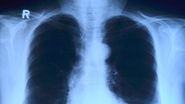 Ce este pneumonia și ce trebuie să știe toată lumea despre boala care l-a ucis pe actorul Val Kilmer. Medicul pneumolog Beatrice Mahler "Orice pneumonie care necesită suport ventilator poate avea o evoluție posibil spre deces" | EXCLUSIV