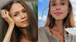 Karolina a murit la 27 de ani, după ce a urmat o dietă doar cu fructe! Ajunsese să cântărească doar 22 de kilograme și abia se putea ține pe picioare