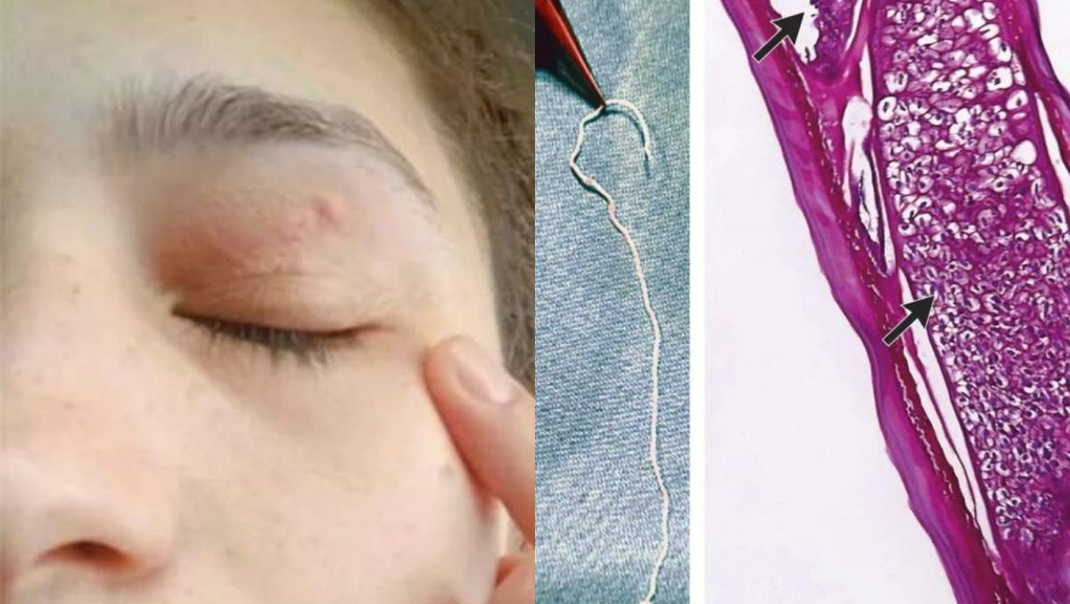 Cazul care a șocat medicina din România! Vierme de 11 centimetri, descoperit în pleoapa unei femei