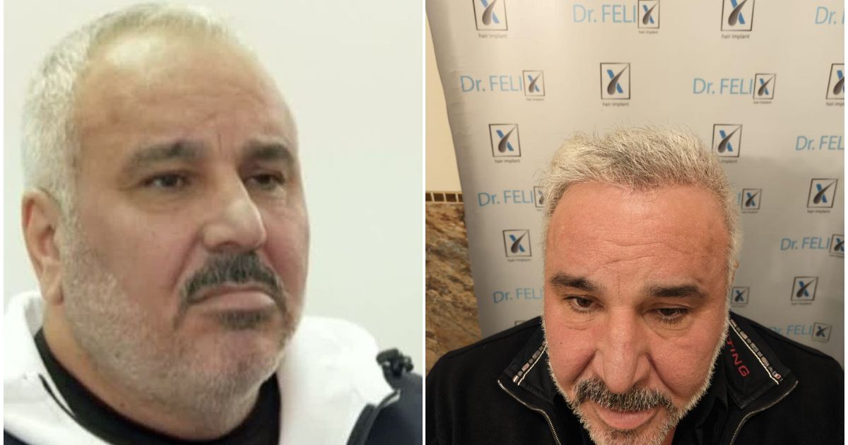 Sile Cămătaru, schimbare de look. Și-a făcut implant de păr la medicul vedetelor și pare întinerit cu ani buni