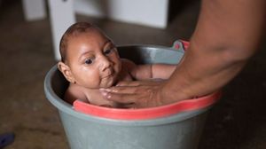 Asa arata un copil brazilian care a contactat virusul Zika
