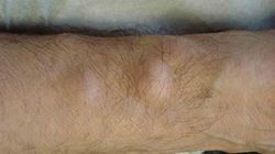 Genial! Cea mai simpla metoda de a scapa de lipom in mod natural, la tine acasa!