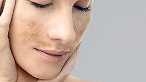Foarte tare! Scapa de petele de pe fata cu ingredientele astea doua! Fac minuni! novalue