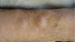 Cum poti scapa de tesutul adipos (lipom) int-un mod complet natural