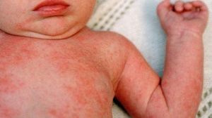Epidemie de rujeola in Romania! Situatia devine grava. A fost confirmat cel de-al treilea deces din cauza bolii novalue