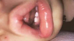 Bona i-a spus unei mame ca fetita ei de 1 an si 8 luni si-a rupt un dinte intr-un biscuite! Cand a dus-o pe micuta la medic, mama a fost la un pas de lesin! Ce avea de fapt copila