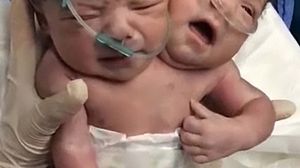 VIDEO Incredibil! Primele clipe de viata ale unor siamezi, imediat dupa nastere! Micutii impart acelasi trup si plang incontinuu