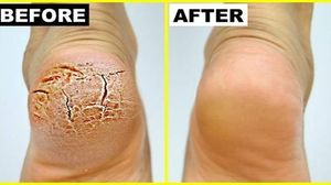 Remediu din bătrâni! Cum să-ţi refaci călcâiele crăpate într-o singură noapte!