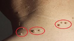 Acest remediu te scapa de negi si veruci! E simplu, nedureros si il ai acasa