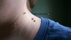 Cum scapi de negii de pe piele in mod natural si simplu